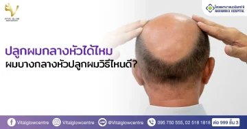 hair-transplat-bald middle-head